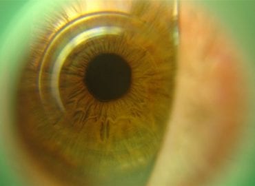 Contact lens for Nearsightedness and Astigmatism
