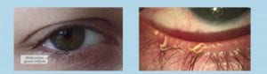 Dry eye treatment Healthy eye vs Dry eye Visual Q Eyecare South Yarra Melbourne Optometrist
